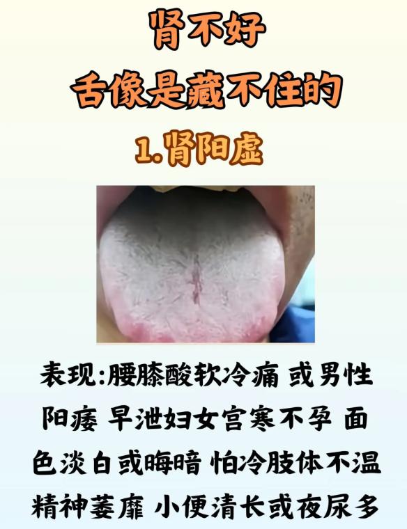 4 种肾气亏虚的典型舌象，一眼分清，别再补错了
