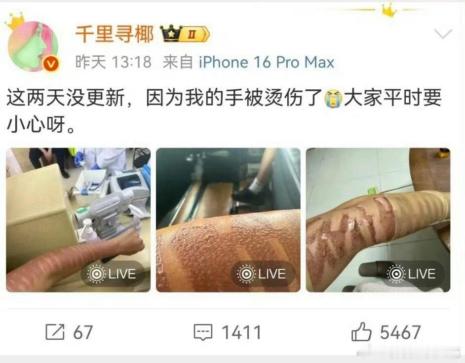 千里寻椰 光子嫩肤二度烧伤不是午餐美容就没风险，操作和设备太关键了。希望后续能妥