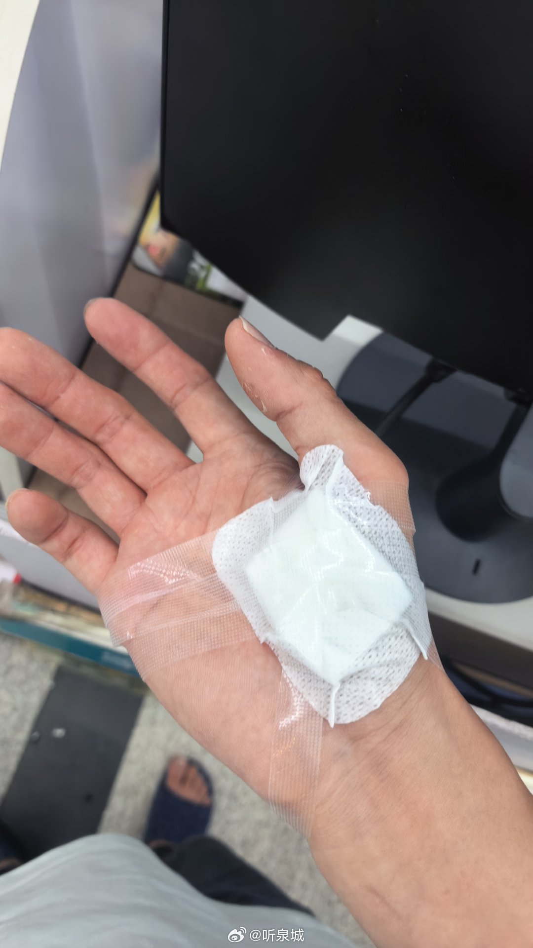 525，我爱我光荣受伤🤕 