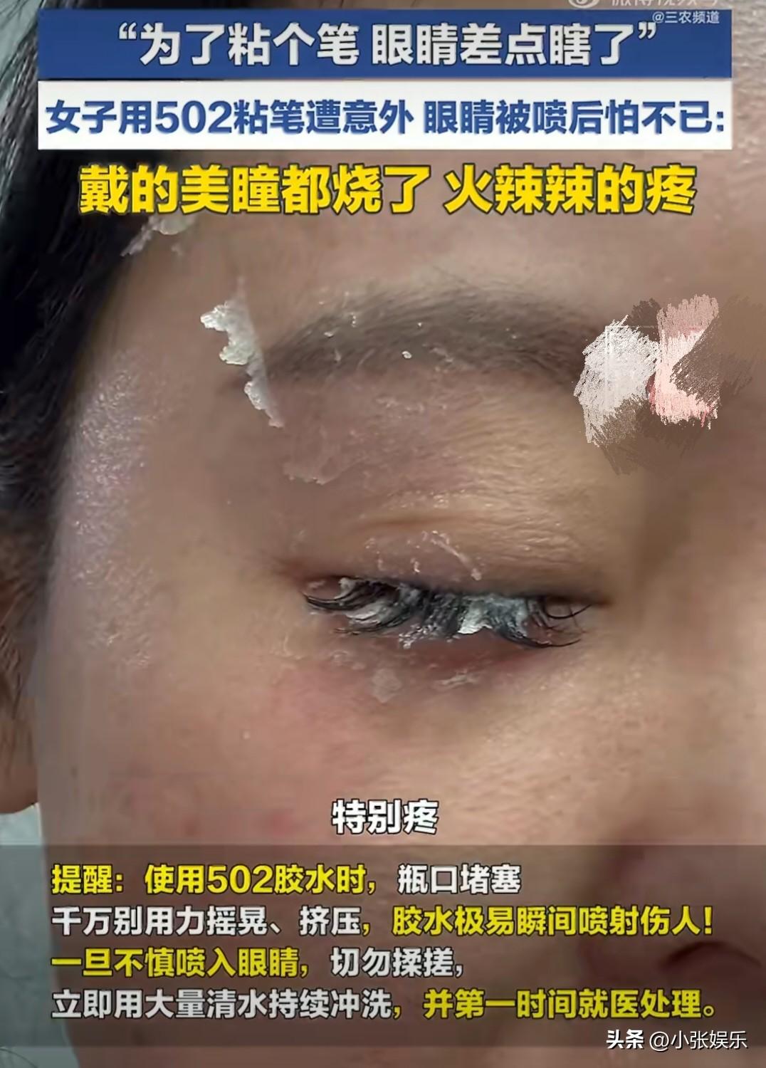 就为粘个笔，眼睛差点废了！502可不能这样用啊！
 
北京一女士为了给孩子粘支破