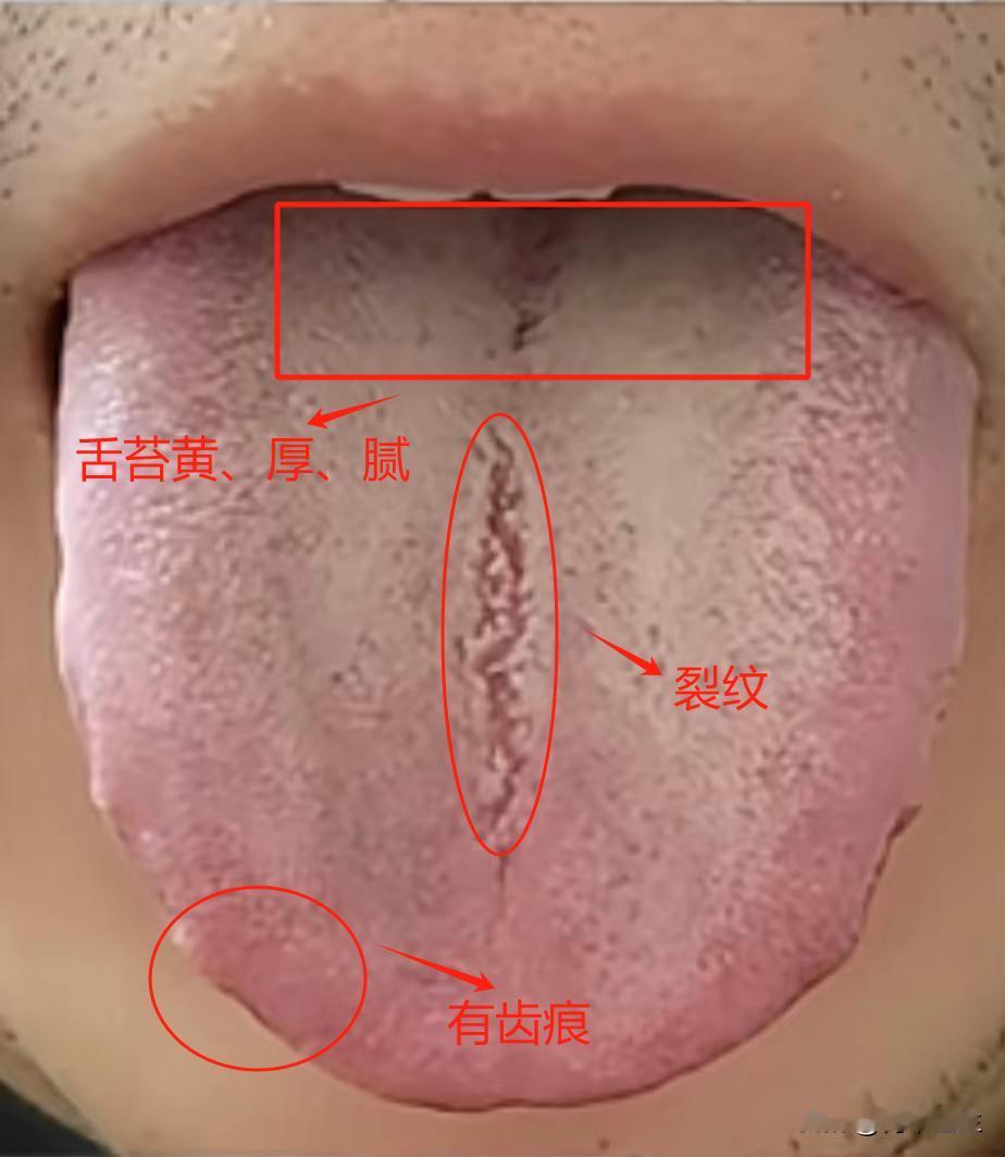 舌头白花花、宗筋疲软，就别吃六味地黄丸了，祛湿才是关键

今天见这个小伙子真让人