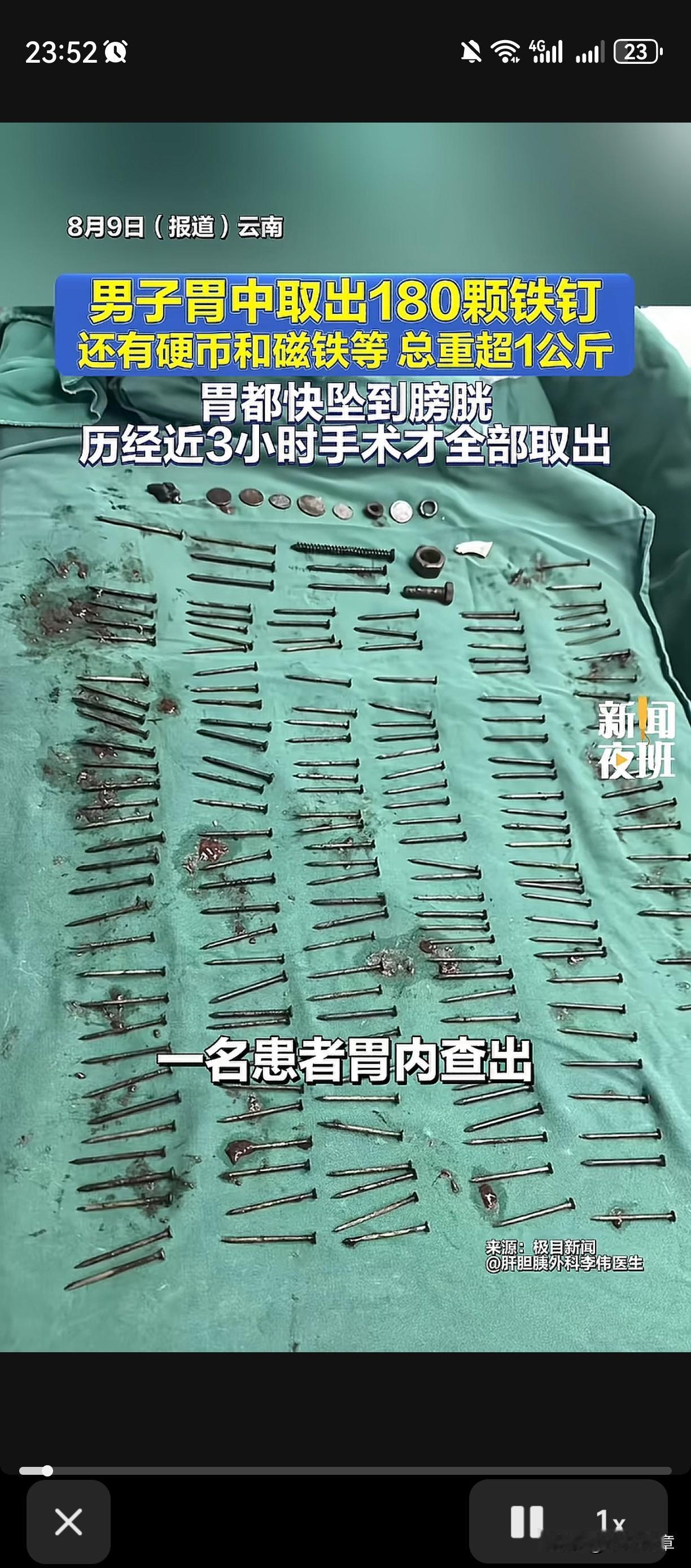 “1公斤重的铁钉”
云南一男子胃里居然塞了180颗铁钉，这太吓人了。
一个人的肚