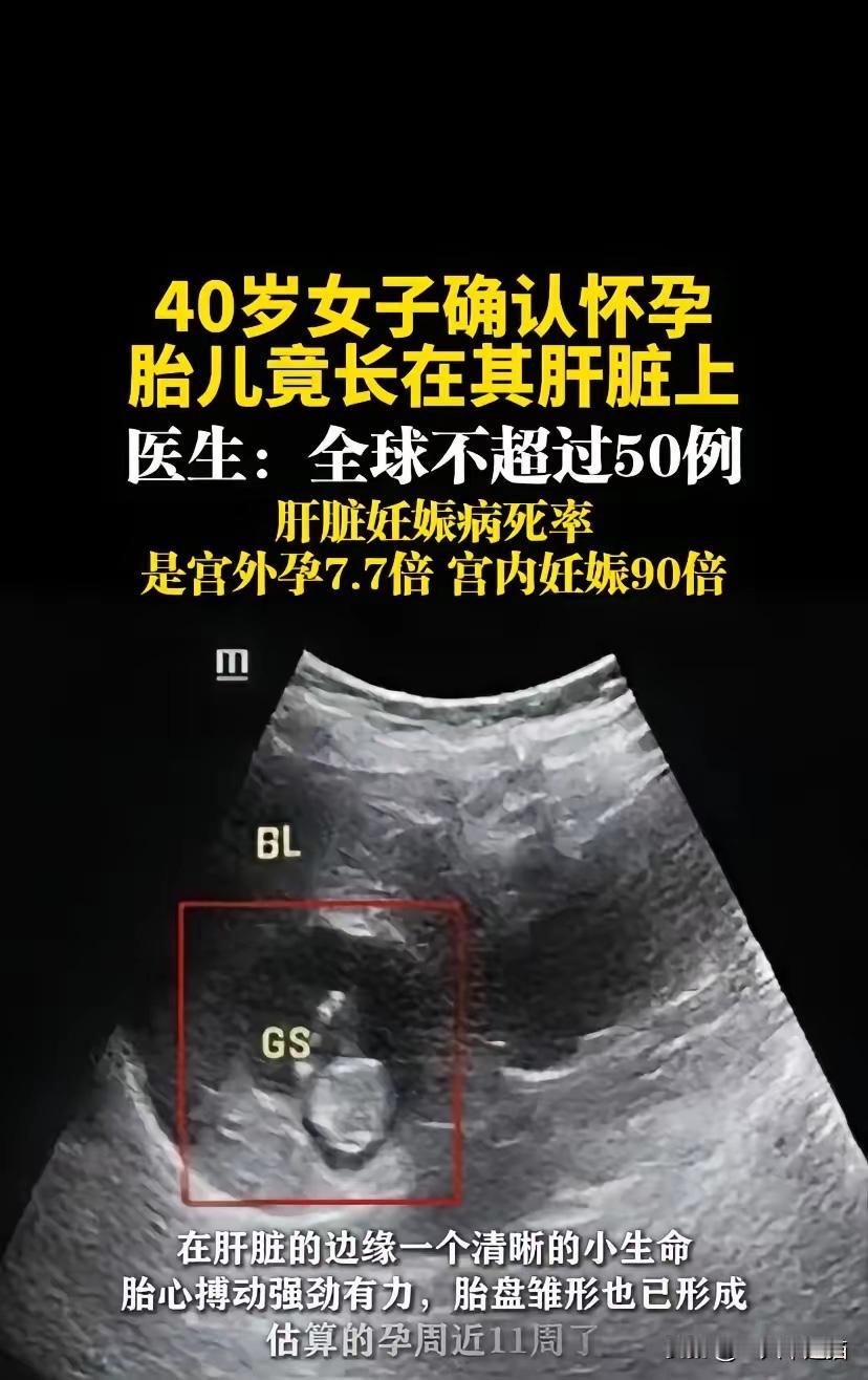 第一次听说怀孕还能怀到肝脏上的，而且不仅仅只有一例，而是全球报道有差不多50例，