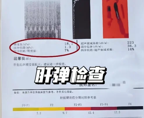 肝弹记住这3个数字，自查肝脏有没有硬化！
