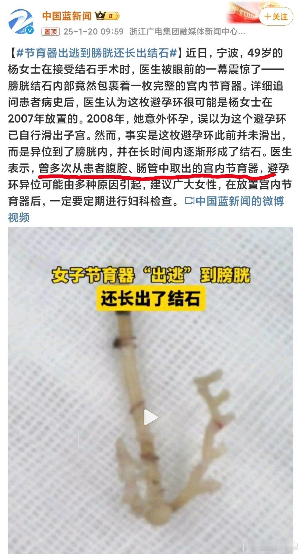 节育器出逃到膀胱还长出结石 向来只宣传让女人上环，仿佛女人身体铁打的 