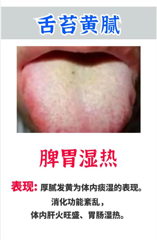 常见舌象与体质：舌苔、舌色反映的健康信号