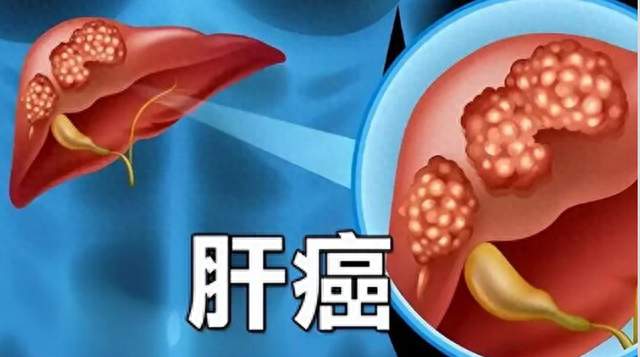 同样是肝脏筛查，普通体检套餐和专科筛查，差距到底有多大？