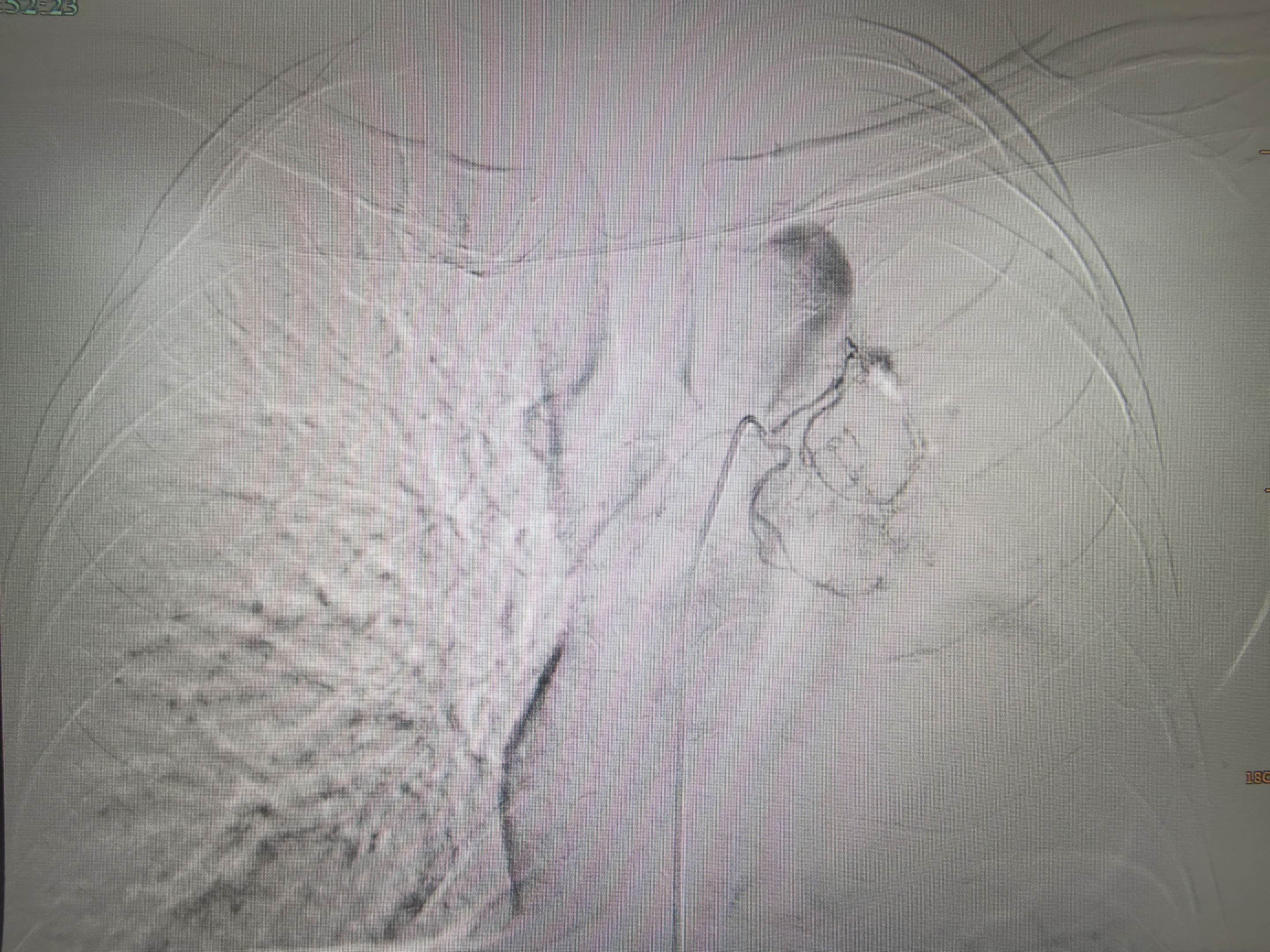 肺癌患者，左肺完全肺不张。经过一次bace的治疗，一个月后复查CT左肺...