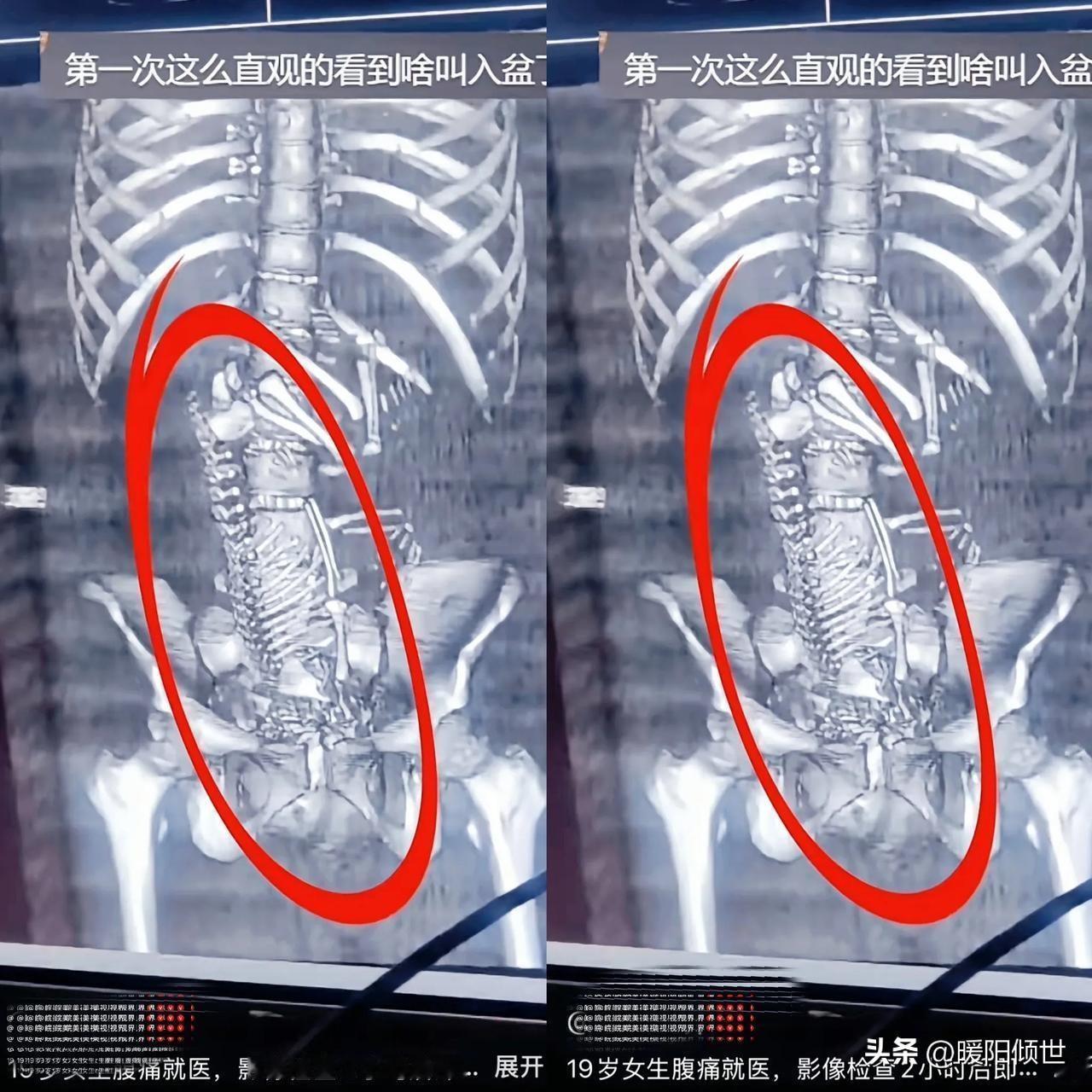 这事儿真笑不出来！“隐匿性妊娠”背后，是性教育缺失的警钟！ 🔔
刷到这个新闻，