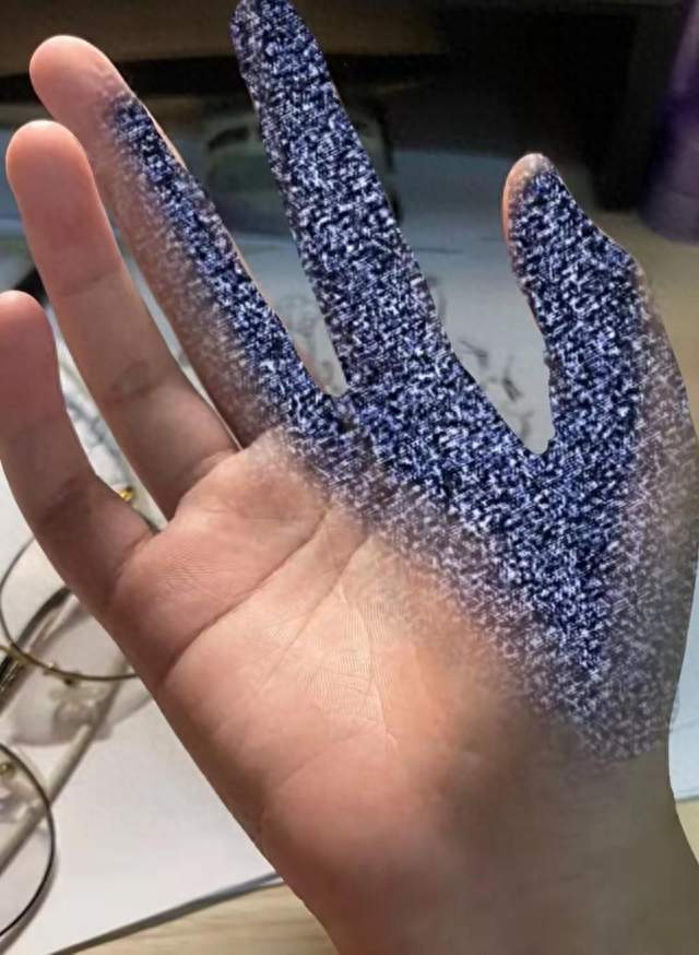 手麻六年当颈椎病治，花光十万块，病根竟藏在手腕里！