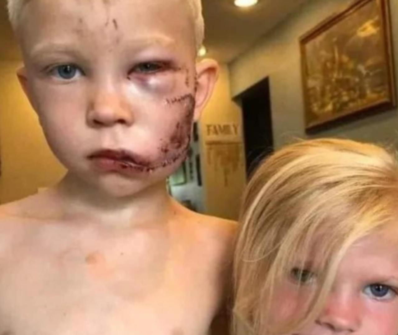 2020年，美国一小男孩从一只牧羊犬口中救出了小妹妹，因此缝了90针，但把他三岁