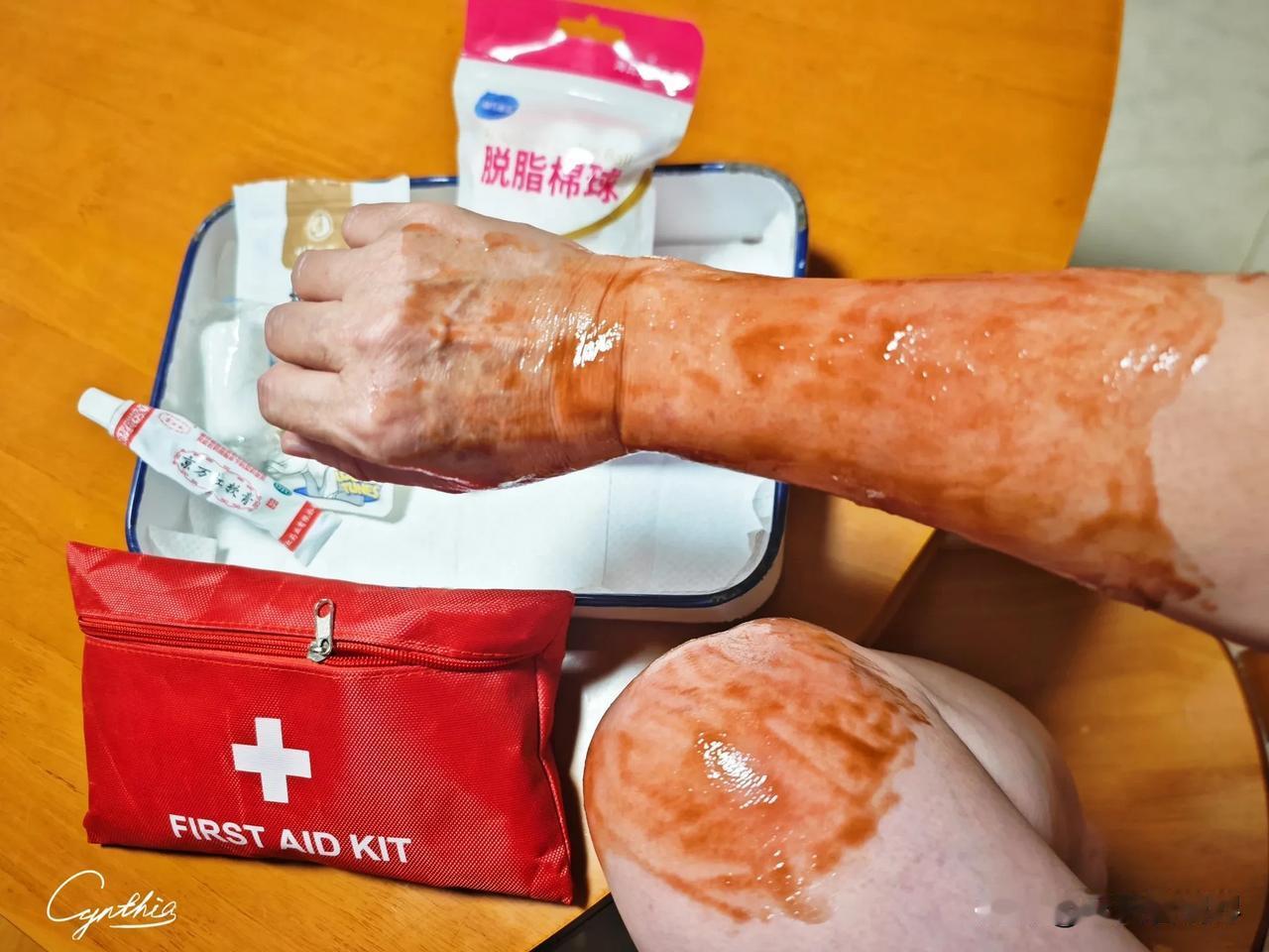 突发！正在电话对接业务事项，谁曾想一不小心碰倒身边沸水壶……即便本能躲闪与猛冲凉