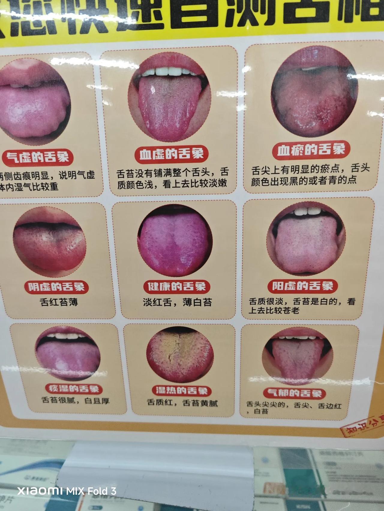 舌象提醒身体状况，这些你知道吗？
快收藏！
 
1. 气虚舌象：舌两侧齿痕明显，