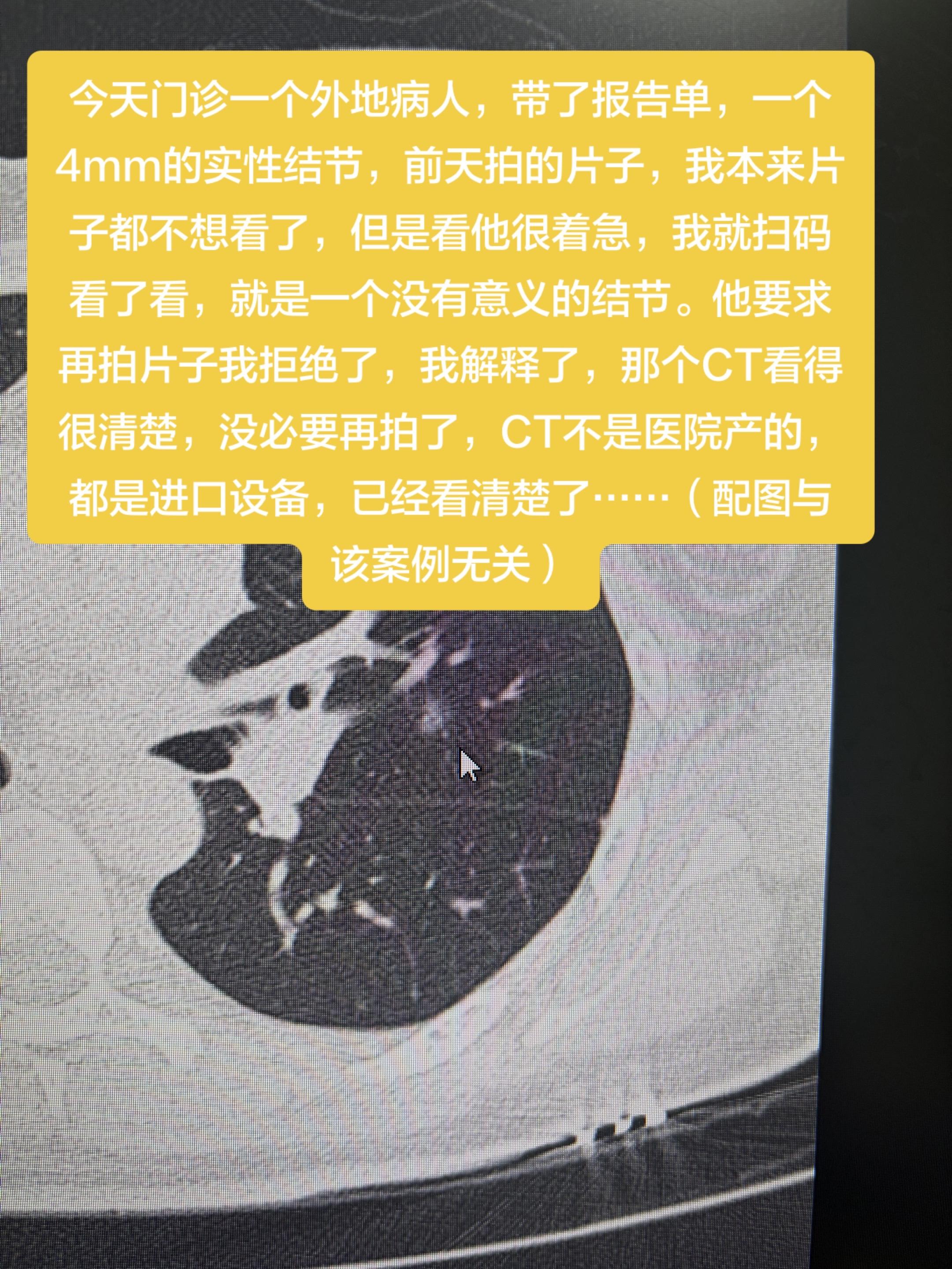 今天门诊一个外地病人，带了报告单，一个4mm的实性结节，前天拍的片子...