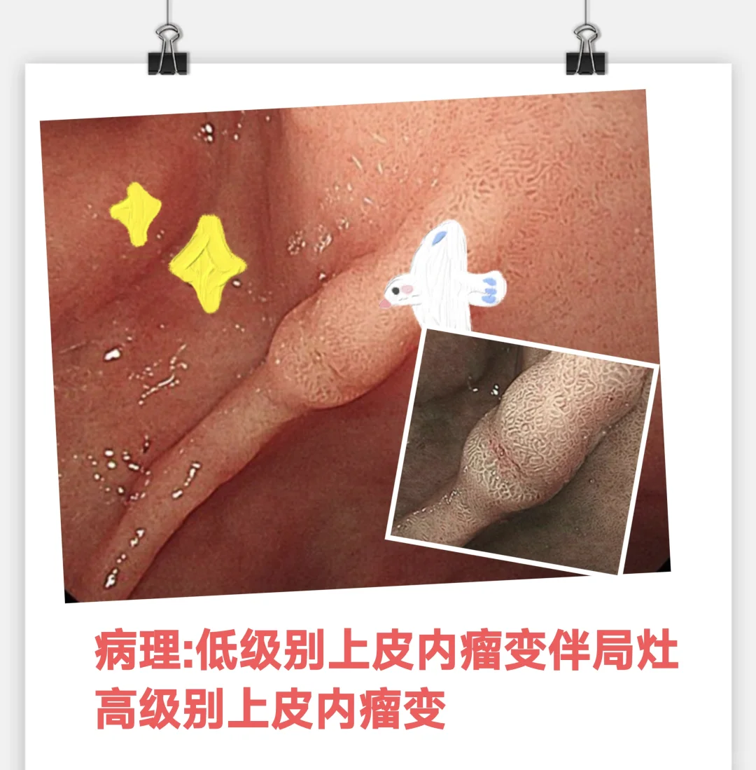 早癌，发现为王！