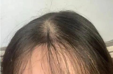 头发越来越稀，你得看看有没有这些情况
想长头发和种庄稼是一个道理，怕庄稼不长，长