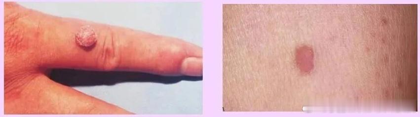 手上的这种小硬结，居然是HPV感染。[喵喵]这是寻常疣，人称“瘊子”，由感染HP