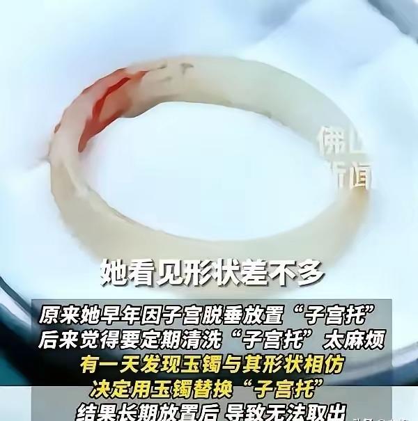 “聪明反被聪明误！”广东，一65岁阿姨因为“下 体异物”去医院检查，结果医生发现