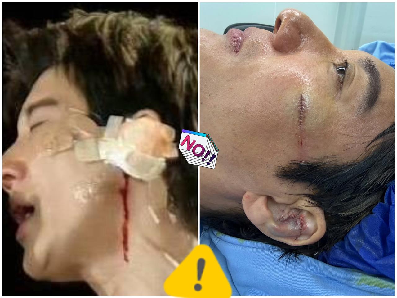 真是外行看热闹，内行看门道！王力宏演唱会摔倒缝了39针，看着只是皮肉伤，其实是个