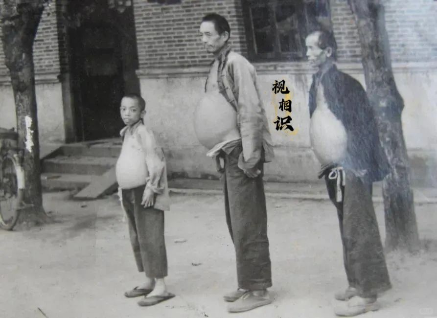 1956年，江苏镇江，一个都患上了“血吸虫病”的祖孙三代的合影，镜头中他们的肚子...