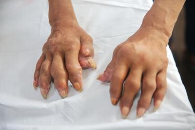 尿酸高引起痛风真的没有办法了吗? 尿酸高引起痛风并非没办法。痛风目前很难彻底治愈