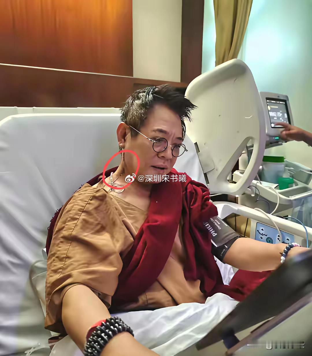 李连杰脖子上开刀，甲亢病情加重了，要知道这是明显的甲亢手术，医生往往在颈脖子上进