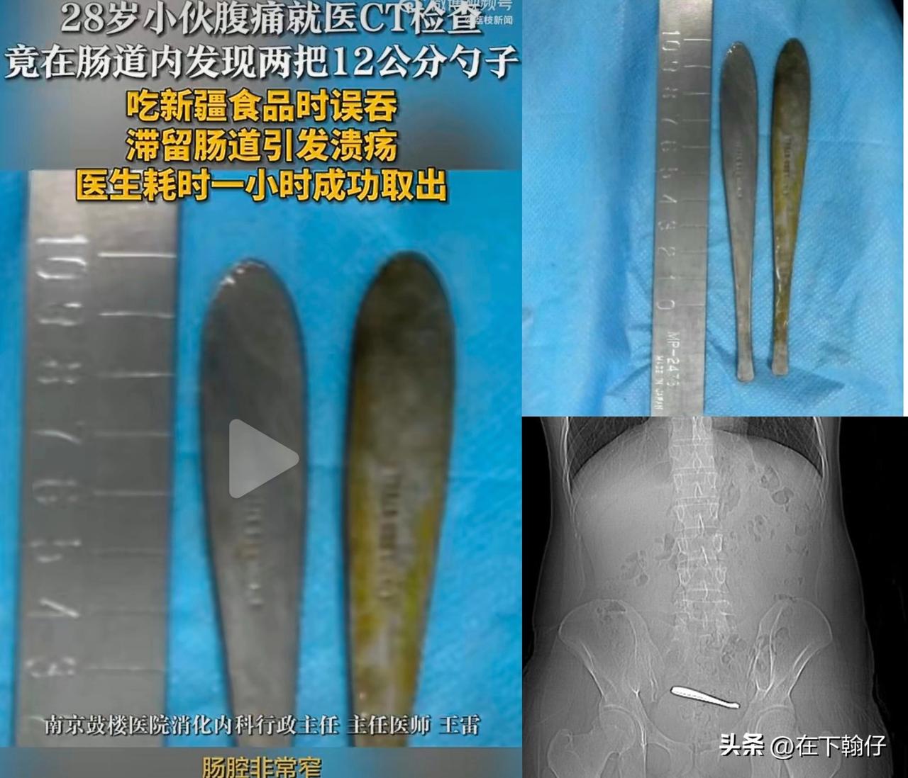 近日江苏南京，一名28岁的小伙因腹痛就医，CT检查发现肠道内竟卡着两把勺子。据患