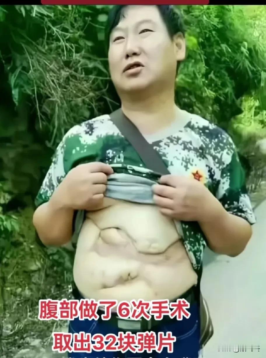 老山一等功臣——雷毅
老山前线，雷毅为了救战友，被炮弹炸成了重伤。
送往医院时，