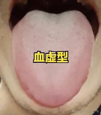 血虚型“起立不坚”：养血填精、益气生血，才能补足身体根本
 
大家好，我是陈大夫