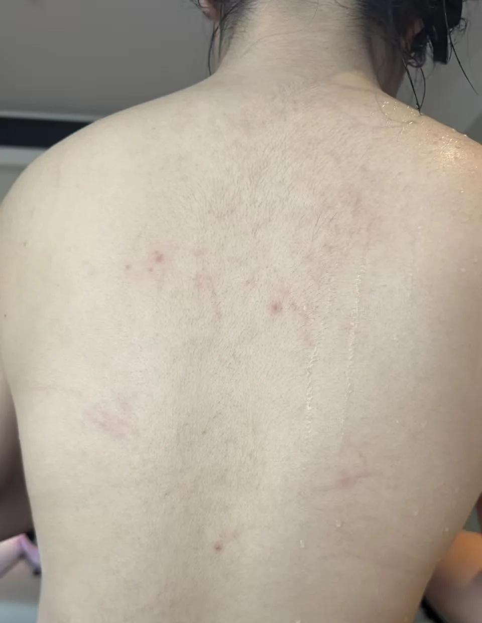 有没有医生朋友帮忙看看这个红疹怎么产生的
事情经过是这样，有个女性客人入住酒店，