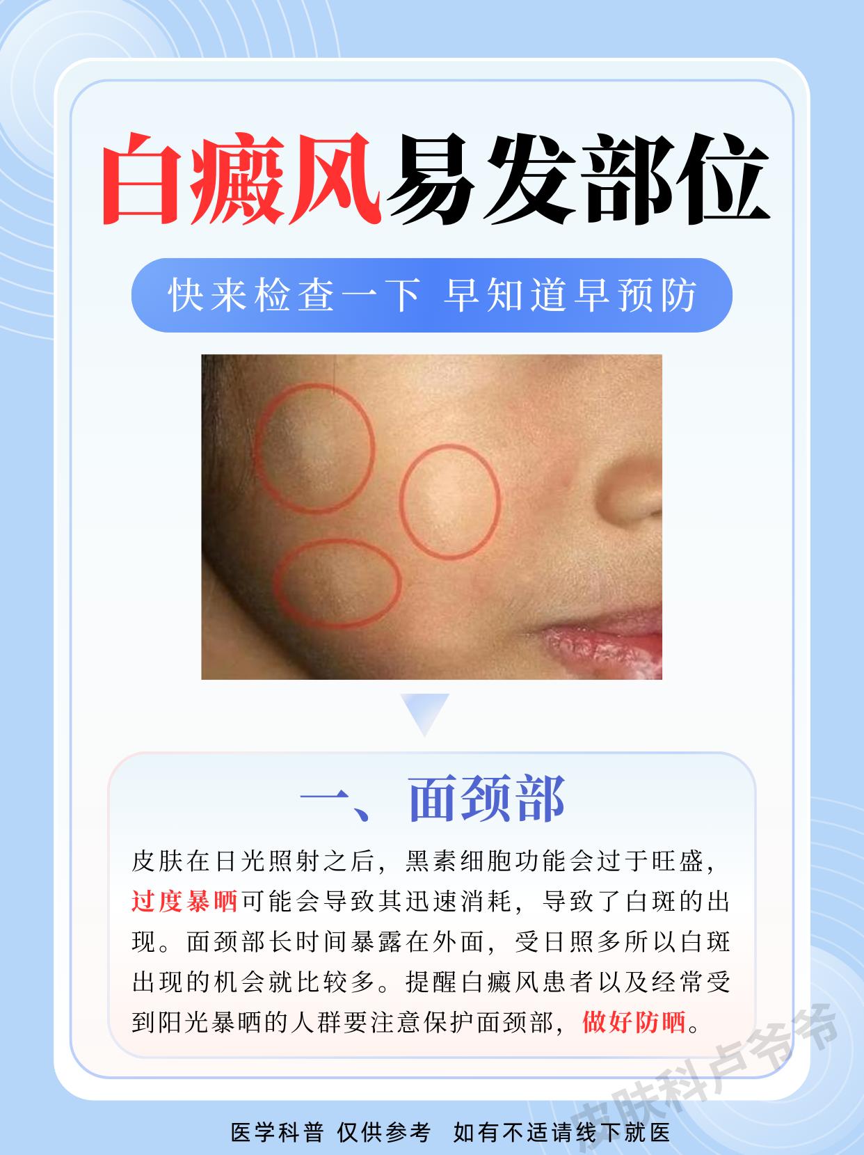 白癜风好发在这些部位，快来检查一下