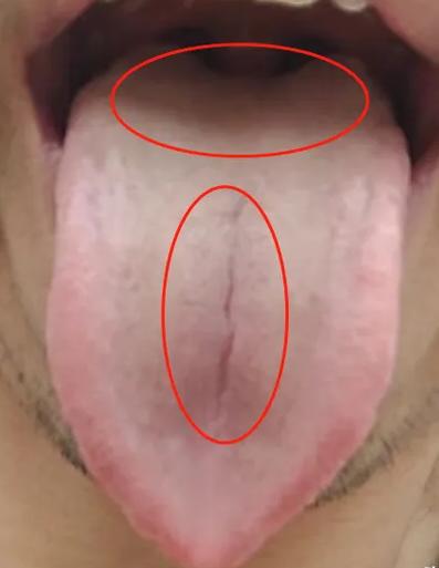 “上车难，下车快”，这种舌象怎么补都没用！关键在舌中间和两边！

先来看这位患者