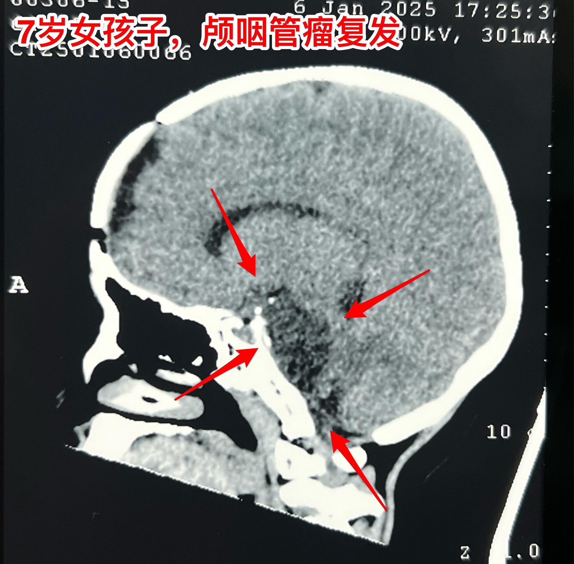 颅咽管瘤复发，看起来是一个瘤其实有三个。7岁女孩子，颅咽管瘤复发。从C...