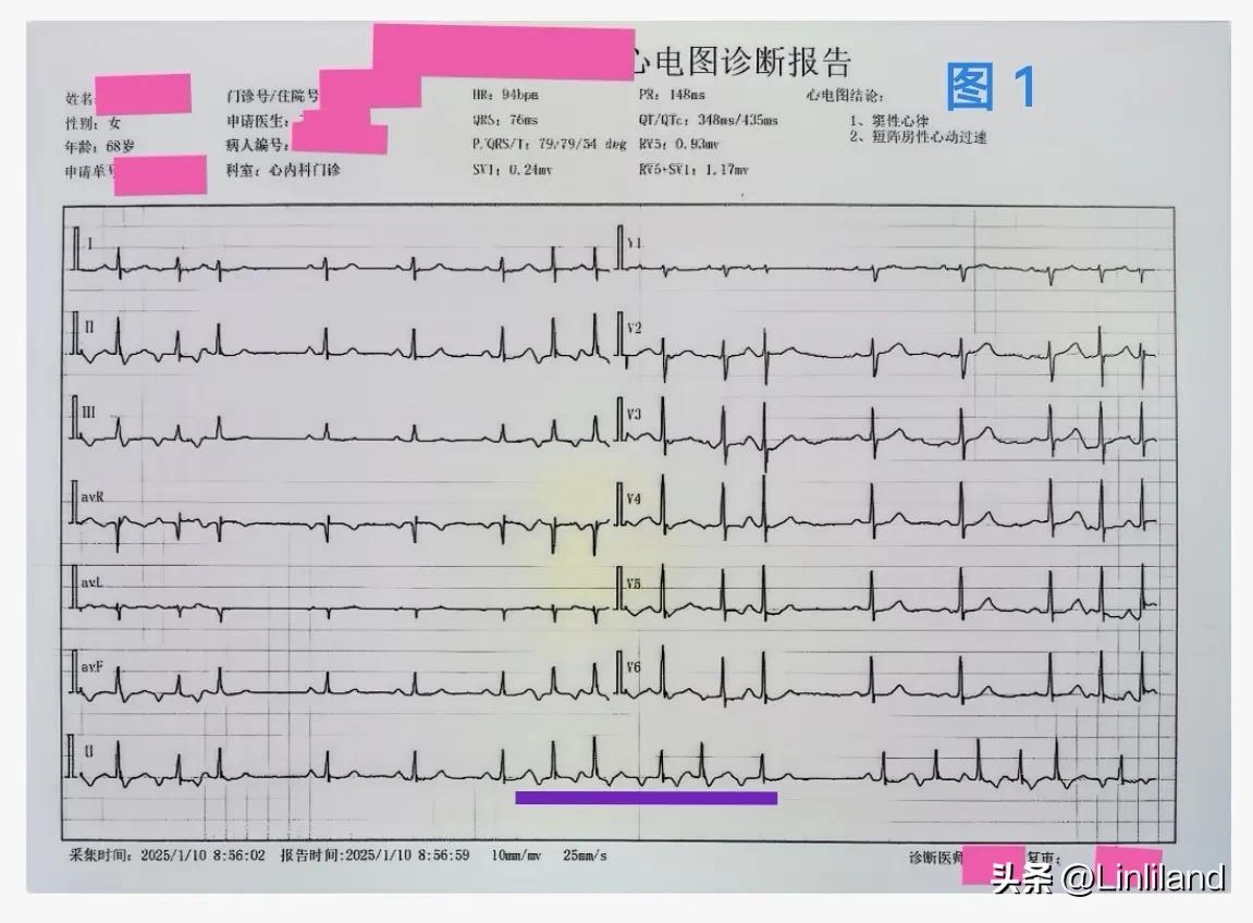 顽固性房性心律失常心电图1例。

患者女性，68岁，因“反复发作心悸、心跳不适”