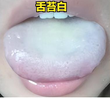 舌苔白是寒，舌苔黄是热，舌苔少是阴虚，记好这三招，老百姓用了都说好！

一、 舌
