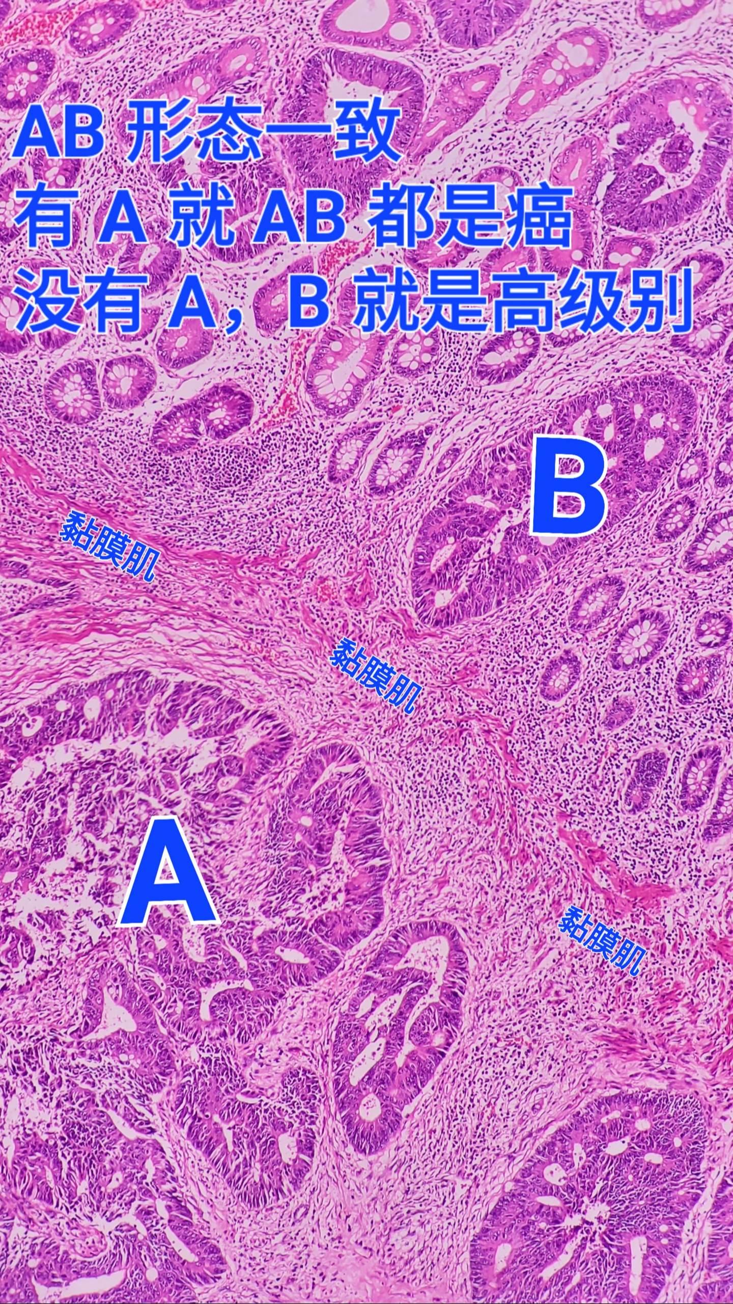 高级别和癌症的区别