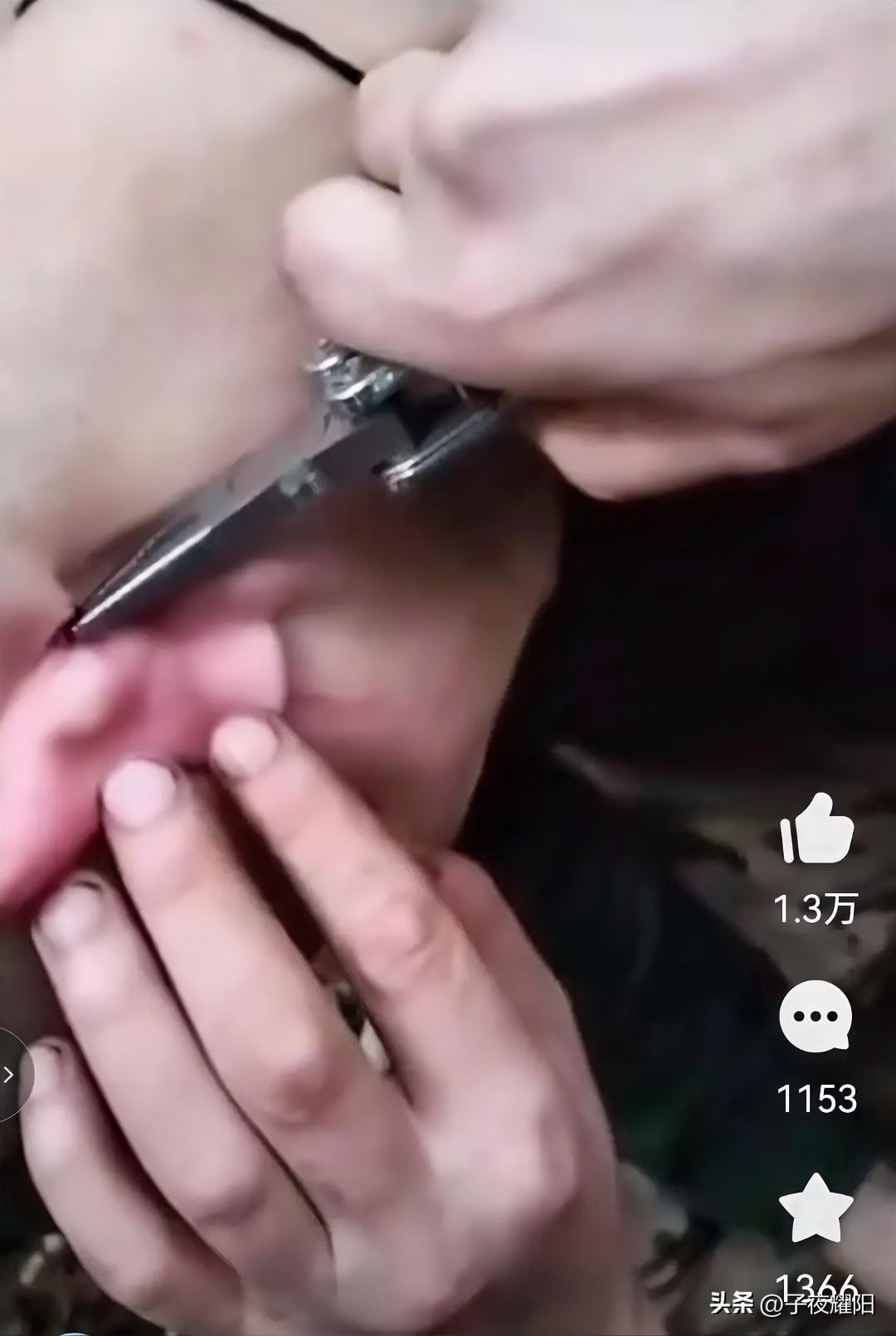 一般人真忍受不了这种痛。下图是一名俄罗斯士兵正在用钳子钳出另一名士兵后脑勺耳根处