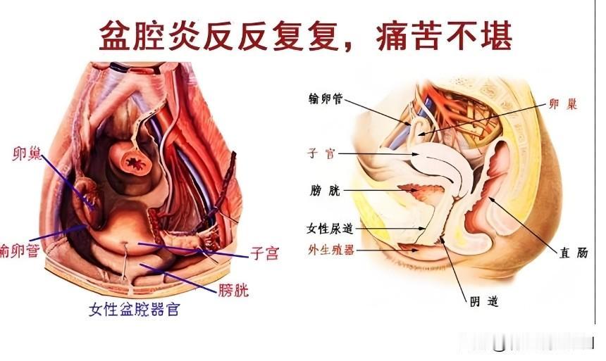 反复下腹坠胀腰骶痛？5个经典中成药调理慢性盆腔炎，温和散结不刺激，一文读懂
 