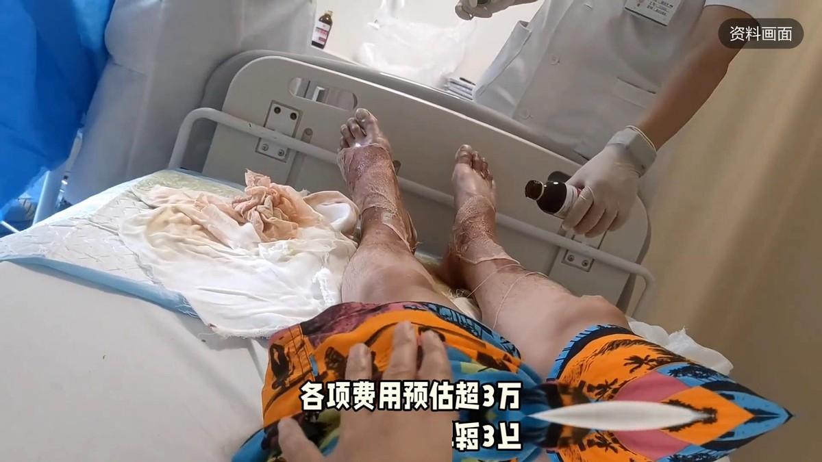 真是人在锅前坐，祸从天上来！谁能想到在深圳吃个火锅，连头都没回，小腿就被滚烫的锅