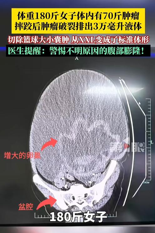 "万万没想到！"5月11日报道，浙江，一女子体重180多斤，肚子很大，一直致力于