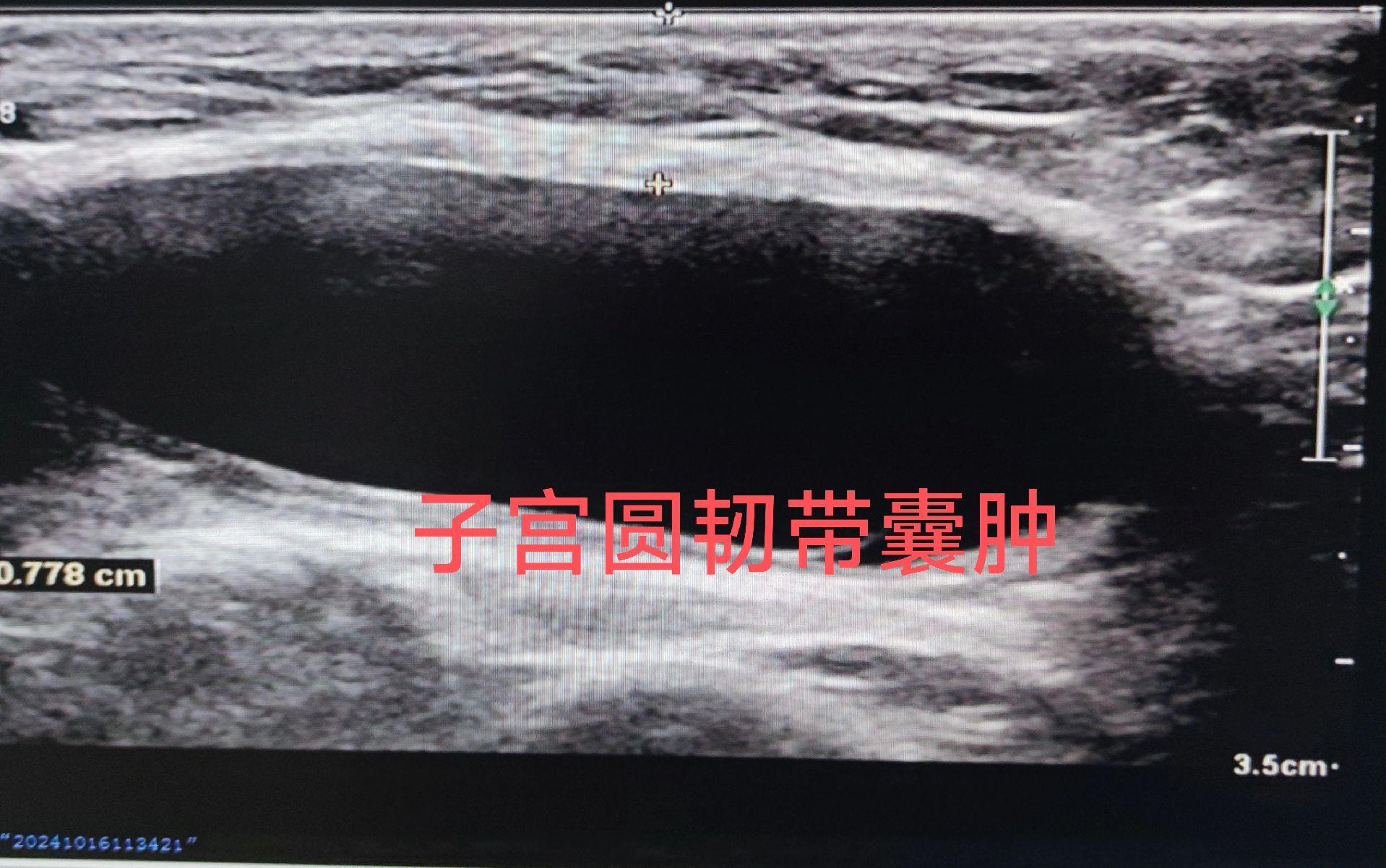 子宫圆韧带囊肿。女，41岁，腹股沟去包块来检查 子宫圆韧带囊肿又叫Nu...