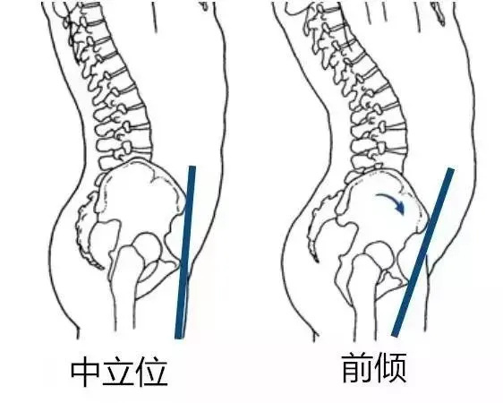 新浪健康必修课 【怎么判断小肚子是胖还是骨盆前倾】如果你明明不胖，小肚子却很突出