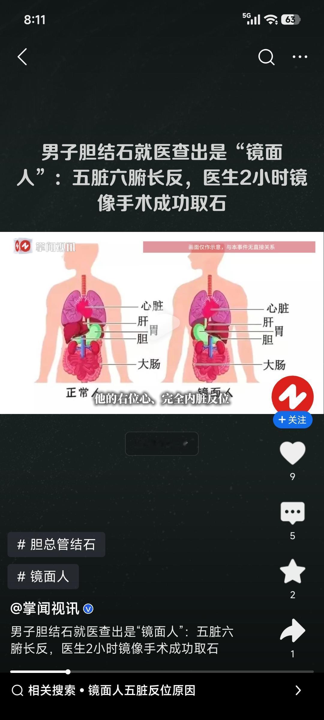 福建发现了一例罕见的“镜面人”，概率低到全球仅百万分之一，比中彩票头奖还难。患者