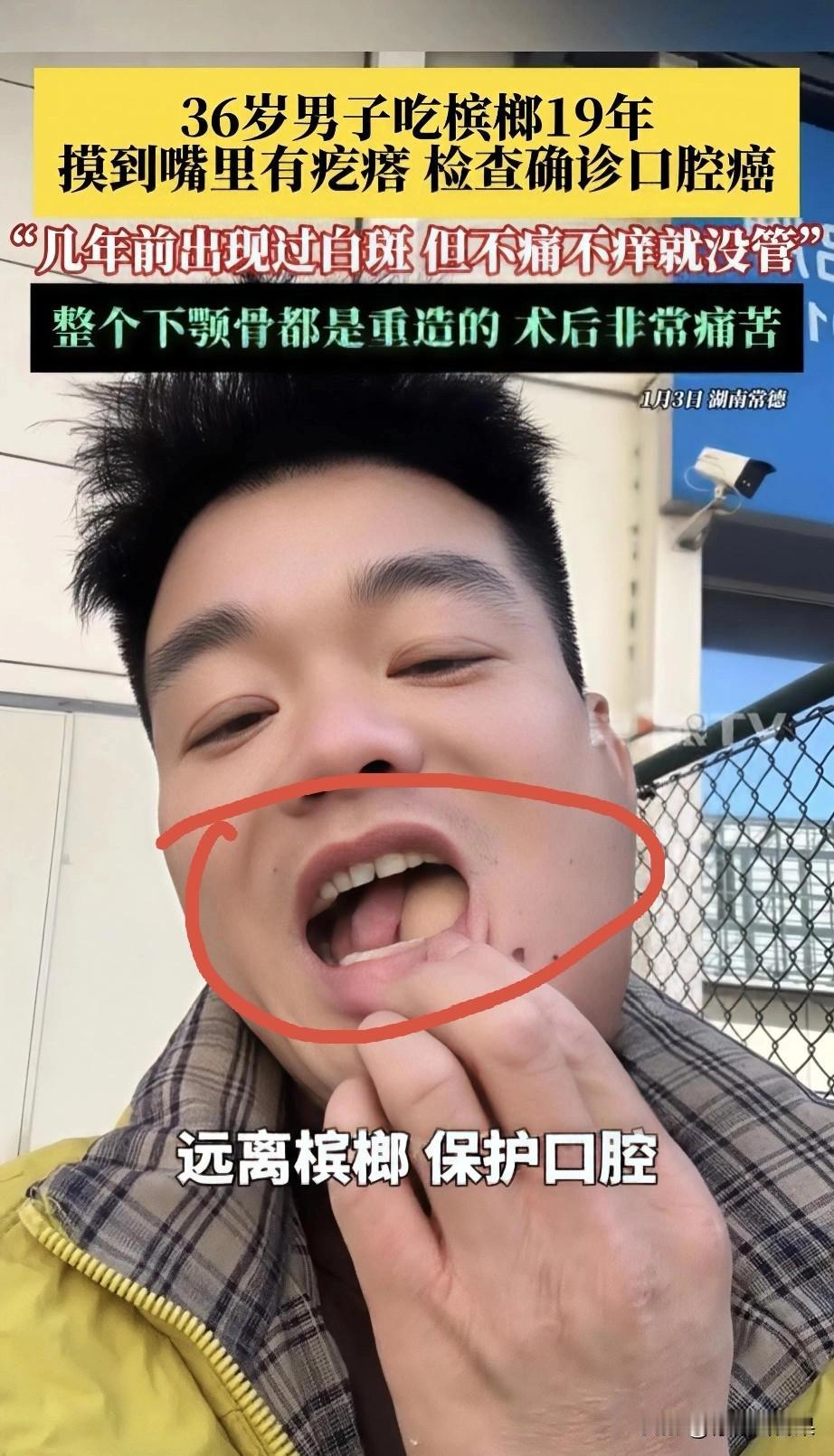 嘴里长白斑没当回事，36岁男子嚼槟榔19年确诊口腔癌！
36岁的张先生嚼了19年