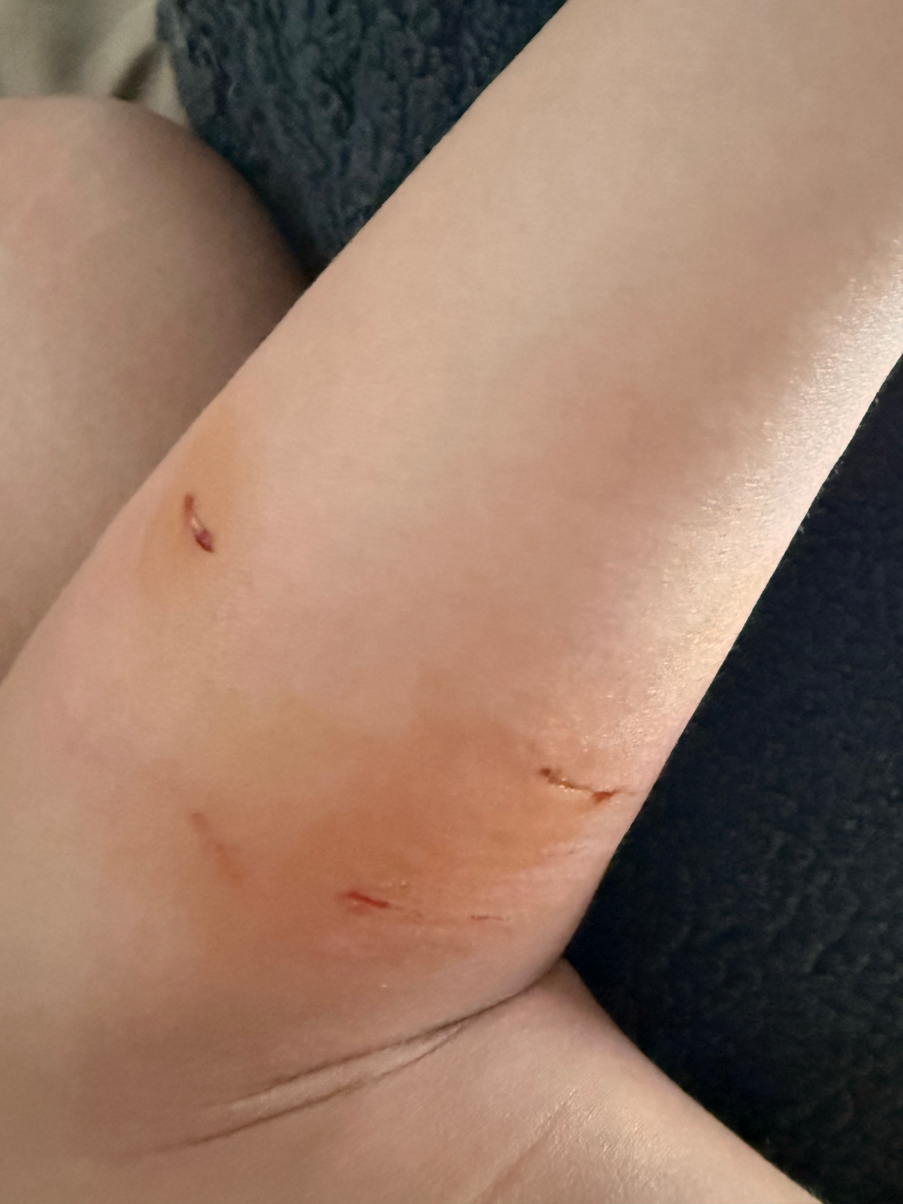 好惨😭朋友家小狗来玩，和我家的打架，我去拉架结果被误伤了[苦涩][苦涩][苦涩