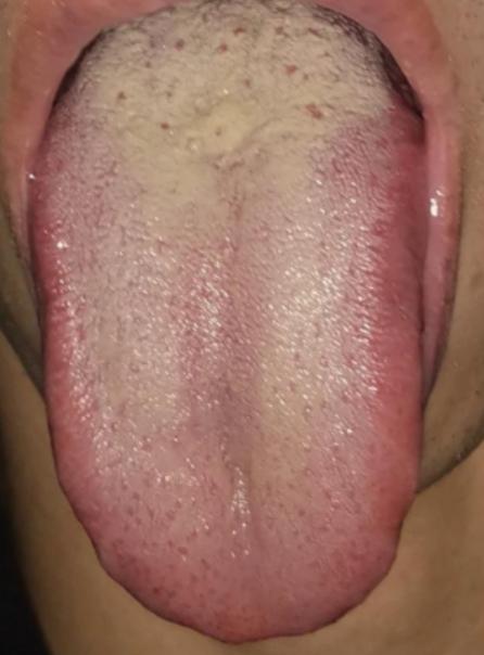 身体里又是火又是热的，竟然还在补肾，这不妥妥的在开玩笑吗！
 
就像这位患者，平