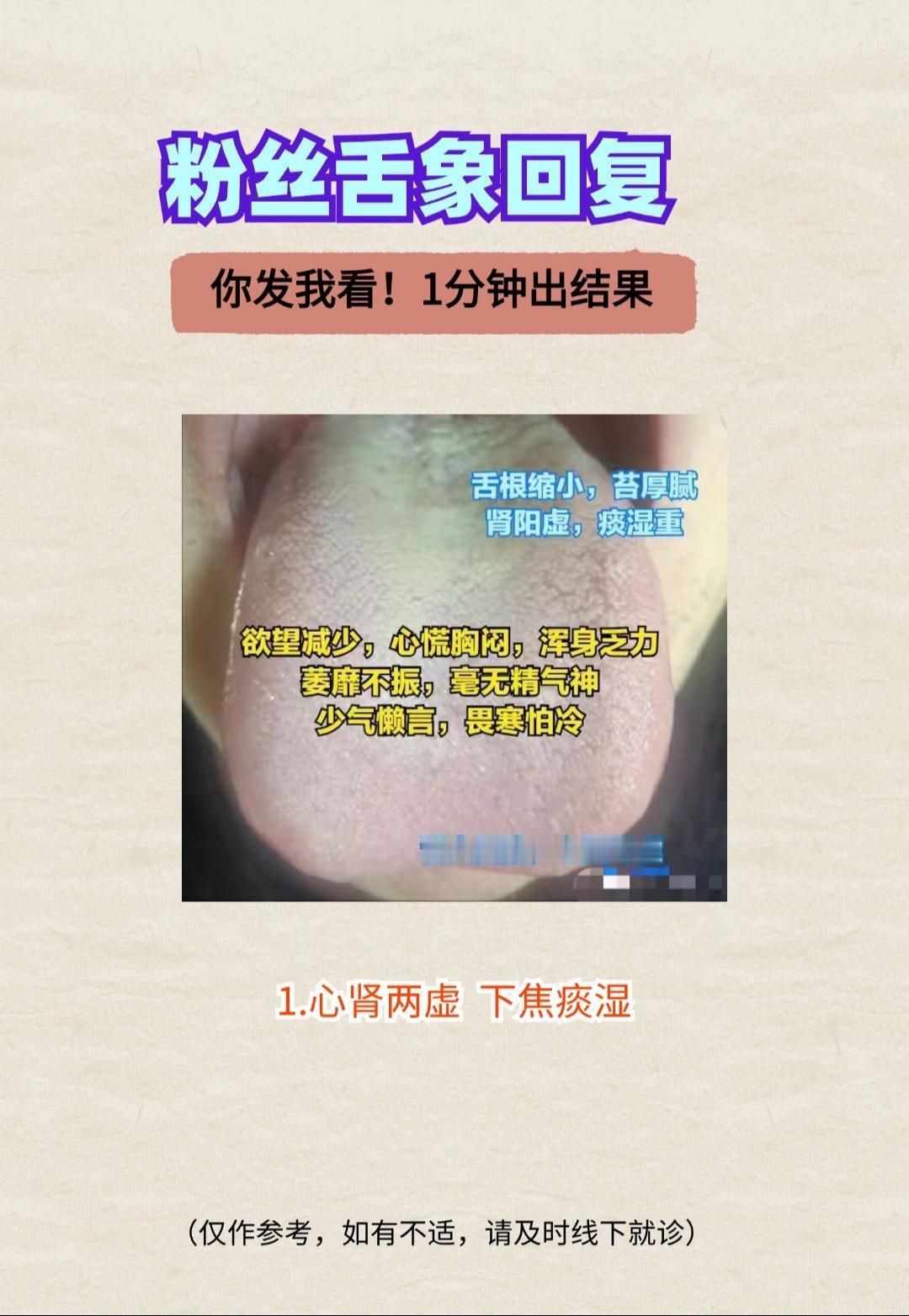 今天分享三个典型舌象：1.心肾两虚 下焦痰湿
2.脾虚 痰湿化热
3.肝郁 脾肾