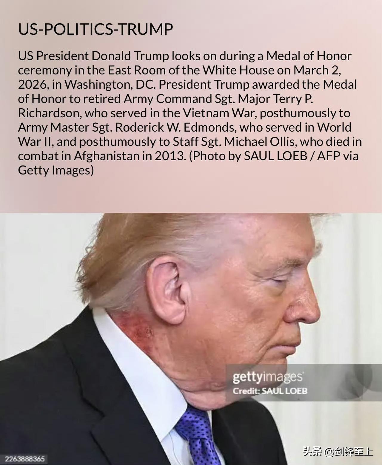 川普这是在爱泼斯坦岛染上毒了？脖子都烂了 ​​​