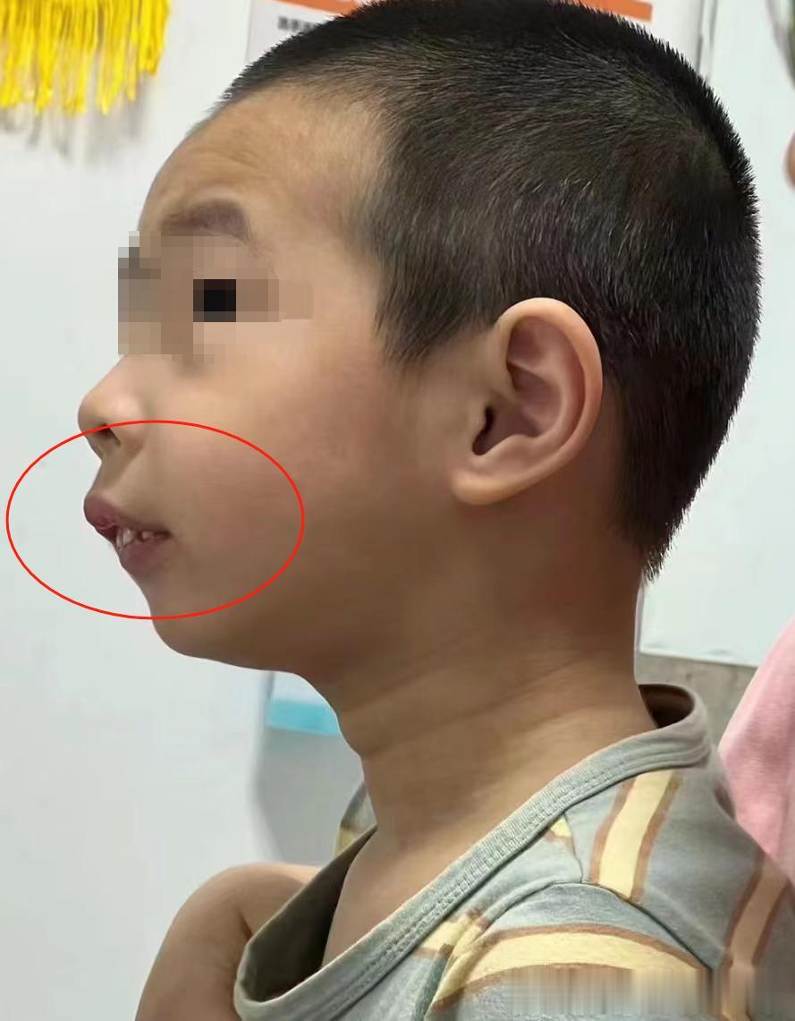 孩子迈向腺样体面容的6个信号，家长务必关注！
 
1、经常揉眼睛或频繁挖鼻孔；
