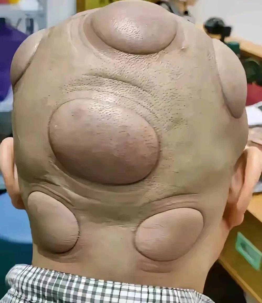 “六花聚顶？太逗了！”一男子最近总觉得头疼，他听朋友说拔罐能缓解，于是就让朋友带